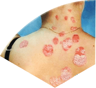 Симптоми на Трихоцефалоза