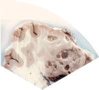 Симптоми на Цистицеркоза