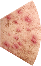 Симптоми на Ентеробиоза